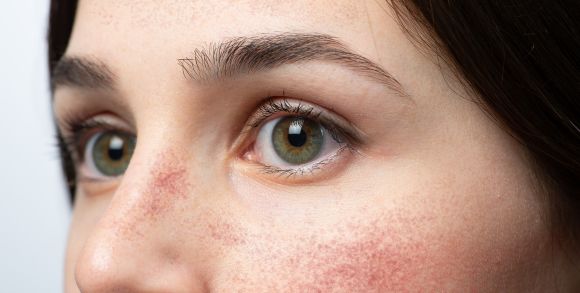 Rötung im Gesicht, Hilfe und Tipps bei Rosacea